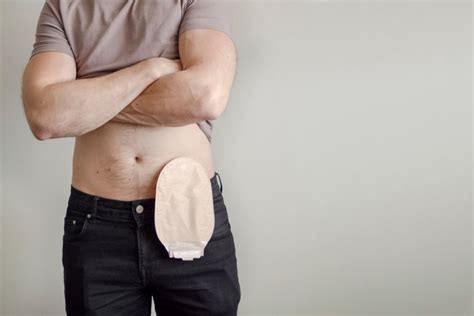 colostomy bag with fake penis|Sex After Ostomy Surgery: Do’s and Don’ts .